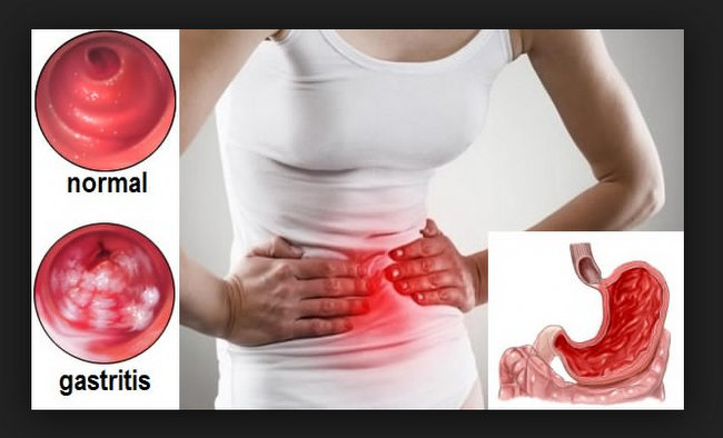 Gastritis